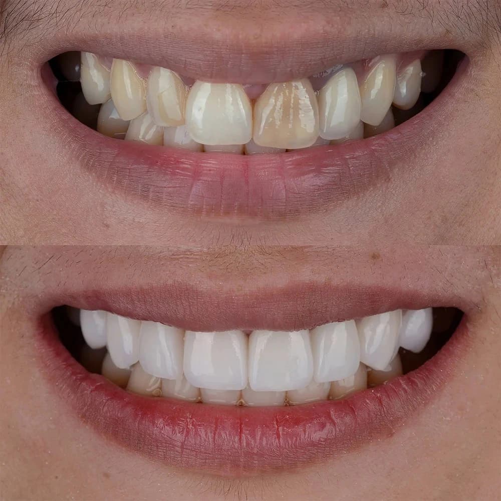 Lamina Veneer